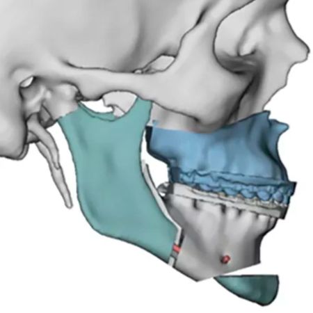 3D diagnosis and skeletal anchorage with miniplate in surgical orthodontic preparation of skeletal Class II: case report