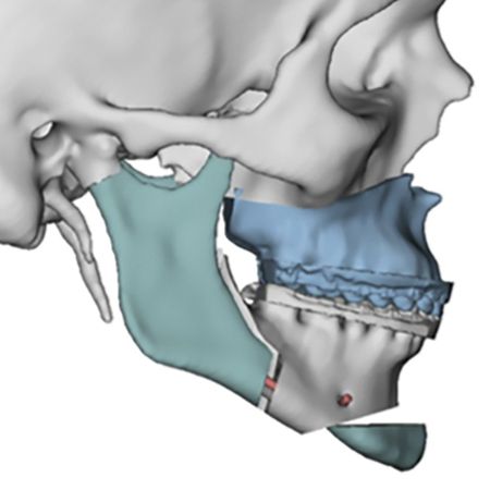 Diagnóstico 3D e ancoragem esquelética com miniplaca no preparo ortodôntico cirúrgico da Classe II esquelética: relato de caso