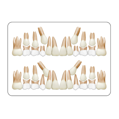 Comparative evaluation of human ß defensin-2 in GCF and microbial flora in subgingival plaque among patients treated with conventional orthodontic braces and aligners: a prospective clinical study