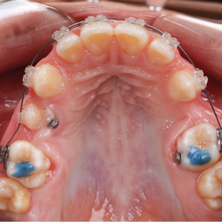 Diferentes técnicas ortodônticas para desrotação de dentes posteriores