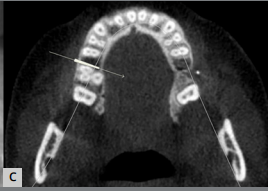 Avaliação com tomografia computadorizada de feixe cônico para determinar a posição e o prognóstico de mini-implantes inter-radiculares