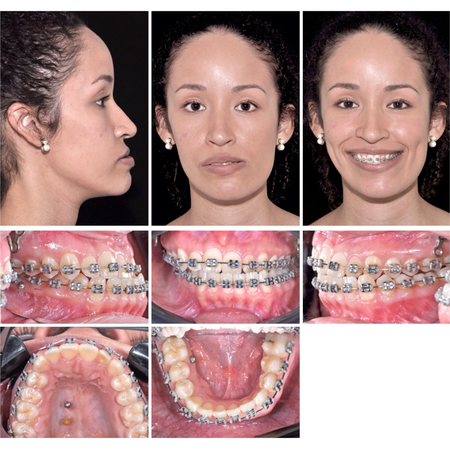 Tratamento ortodôntico-cirúrgico de assimetria facial severa e mordida cruzada vestibular: relato de caso