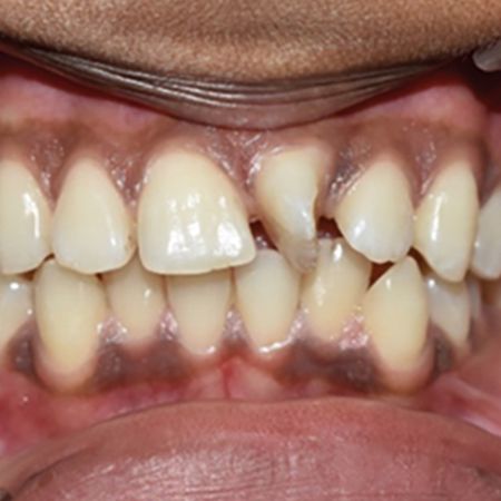 En-masse distalization with infrazygomatic crest and buccal shelf miniscrews in extraction and non-extraction patients