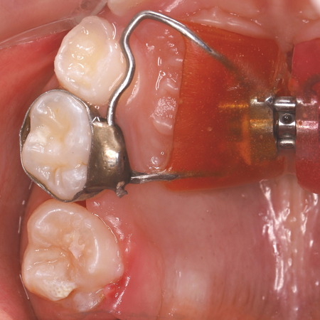 Expansor de Haas na interceptação da erupção ectópica de primeiro molar permanente superior