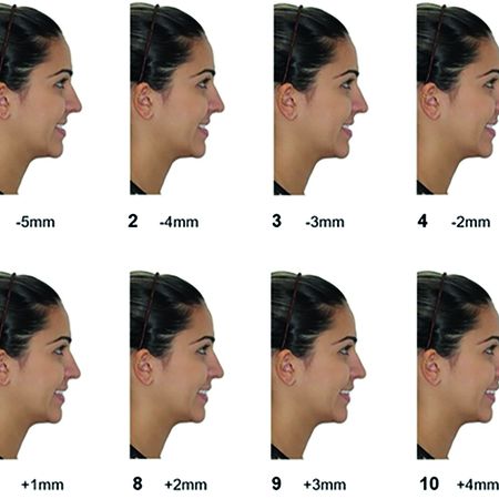 Evaluation of the anteroposterior position of maxillary incisors and its influence on facial attractiveness