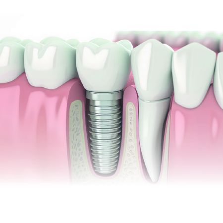 Tratamento periodontal e reabilitador em paciente com fibroma ossificante periférico em área estética: relato de caso, com acompanhamento de cinco anos