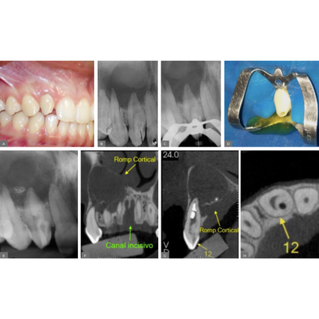 Terapia endodôntica conservadora e cirúrgica no tratamento de dens in dente: relato de dois casos