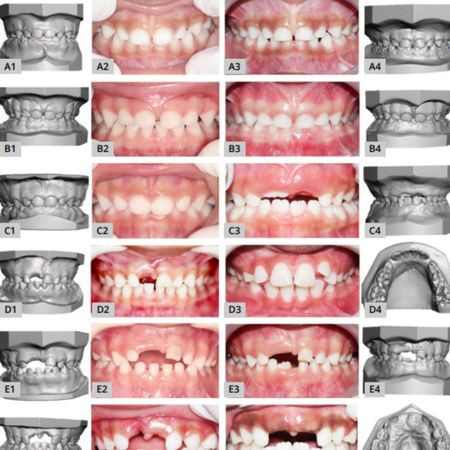 Desenvolvimento da oclusão após perda prematura de dentes anteriores decíduos: resultados preliminares após 24 meses em um estudo de coorte prospectivo