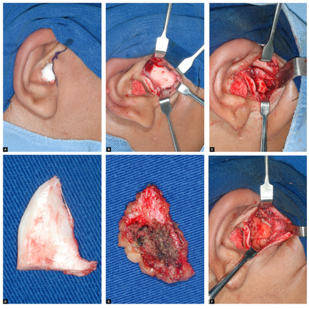Abdominal fat graft in TMJ surgery: retrospective study