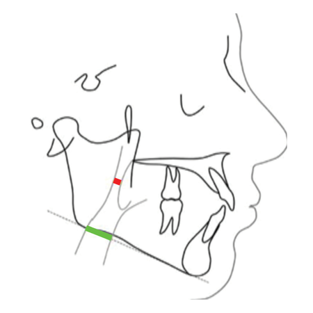 Comparison of facial soft tissue thickness, pharyngeal airway widths in different skeletal Patterns