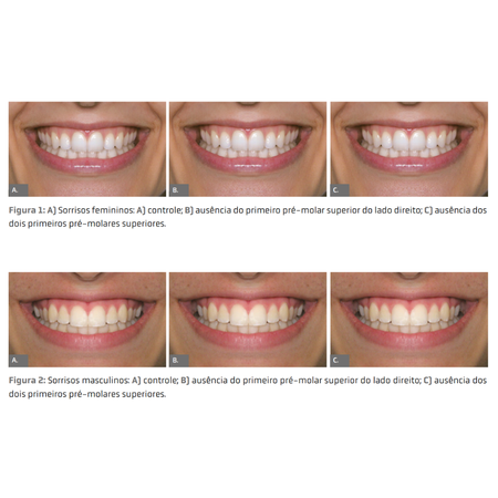 Does unilateral or bilateral absence of the first premolars influence the smile esthetics perception?