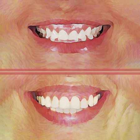 Correção ortodôntica do sorriso gengival e posicionamento de incisivos superiores: sinergia ou desafio
