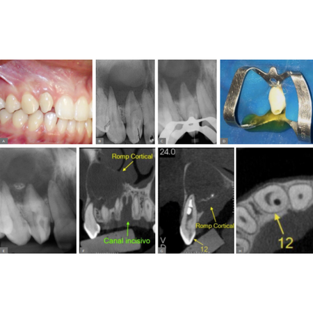Conservative and surgical endodontic therapy on treatment of dens invaginatus: report of two cases