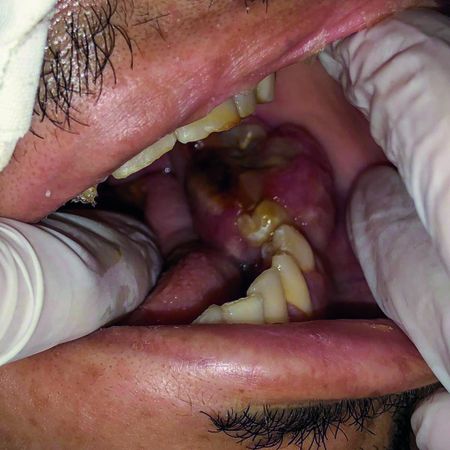 Mandibular sporadic Burkitt’s lymphoma: Case report