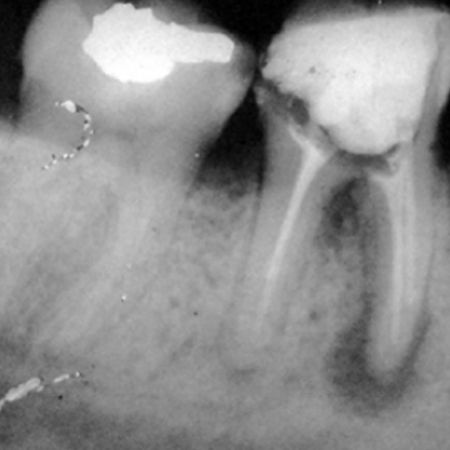 Radiographic quality of endodontic treatments performed by undergraduate students at the Federal University of Santa Maria