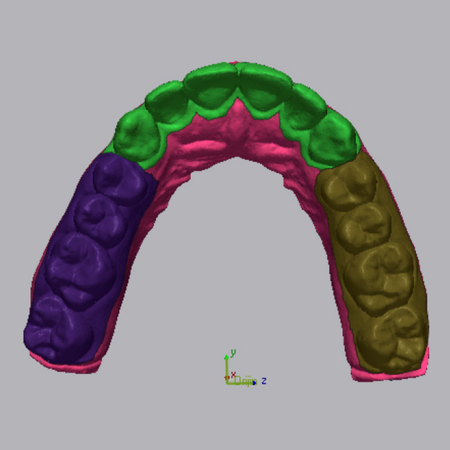 Impact of different levels of diastema and crowding on the precision of 3D-printed dental models: a comparative analysis using digital superimposition