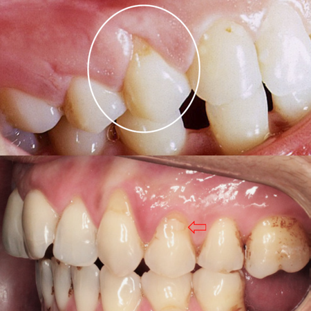 The five ‘truly’ cervical injuries or diseases. Part 2: Dental abfraction