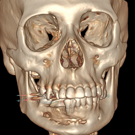 Treatment of unicystic ameloblastoma in mandibular body: a case report