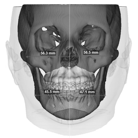 Estudo tomográfico das variações do ângulo mandibular em diferentes tipos de deformidades faciais no âmbito da harmonização orofacial