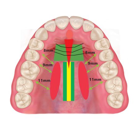 Orthopedic maxillary expansion in adults. Part 2: SARPE X MARPE X TS-SARPE techniques