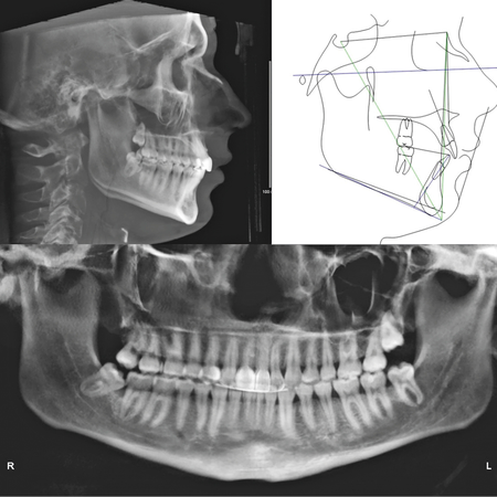 Orthodontic and restorative management of central incisor avulsion with lateral incisor substitution: seven-year control