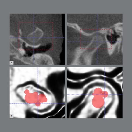 Three-dimensional assessment of mandibular asymmetry in patients with unilateral cleft lip and palate at different growth stages: a cross-sectional study