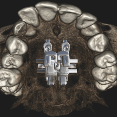 Advances in rapid maxillary expansion: comparison of techniques and impact on treatment precision and quality
