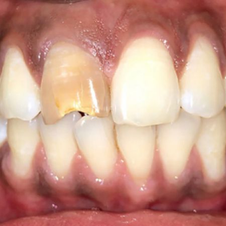 Management of necrotic immature permanent tooth with regenerative endodontic protocol using CGF as adjunctive scaffold: a case report with two year follow up