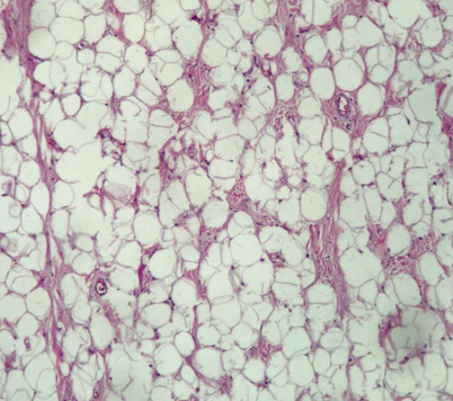 Abordagem cirúrgica de lipoma oral: relato de caso