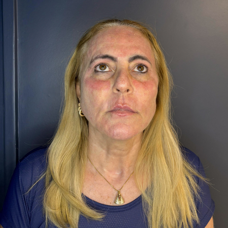 Tratamento com laser fracionado de CO₂ em região periorbital de paciente com síndrome de Sjögren, tireoidite de Hashimoto e fibromialgia: relato de caso