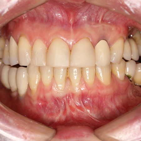 Osteoma de côndilo mandibular como principal causa de assimetria facial progressiva e dor intensa: Relato de caso