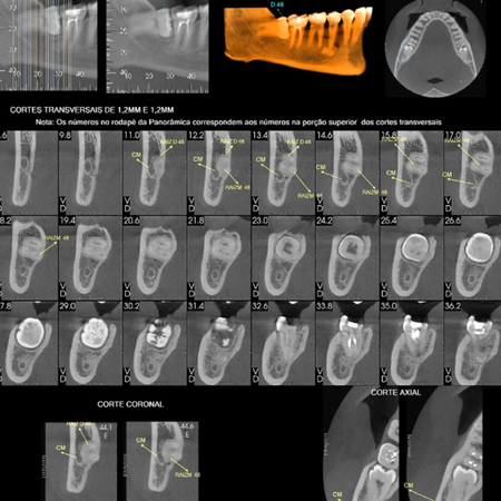Mandibular canal course variations: clinical case series