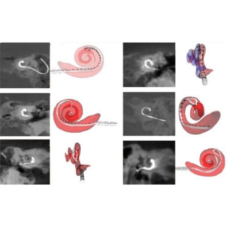 Use Of The Nucleus Smartnav® System In Intraoperative Telemetry Of Cochlear Implant