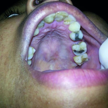 Hard palate cystadenoma: report of a rare case