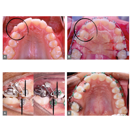 Protocolo de distalização com aparelho Pendex: passos clínicos e biomecânica