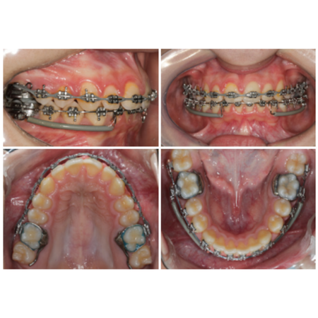 Rapid maxillary expansion performed in a patient with torus palatinus: case report