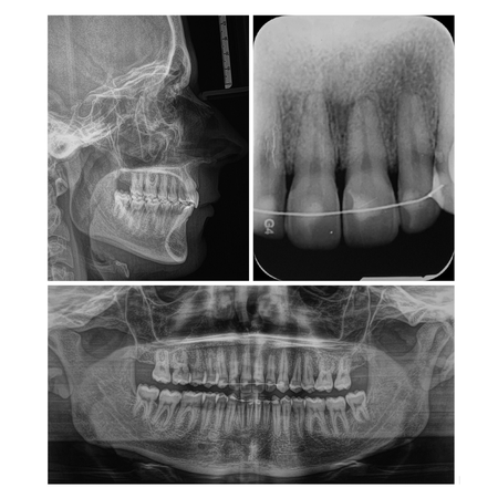 Retratamiento ortodóncico compensatorio de Clase II esquelética y dental con el uso de elásticos intermaxilares con fuerzas asimétricas: reporte de caso