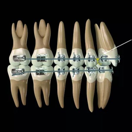 Orthodontic biomechanics with intermaxillary elastics