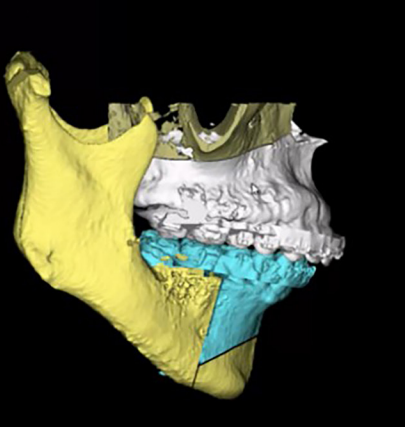 Método cartesiano tridimensional para quantificar deslocamentos em modelos de tomografia computadorizada de feixe cônico