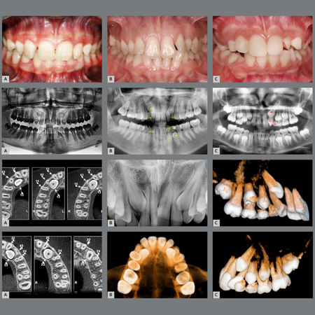 Focus on leveling the hidden: managing impacted maxillary canines