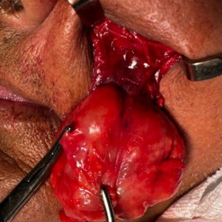 Giant lipoma on the face: case report