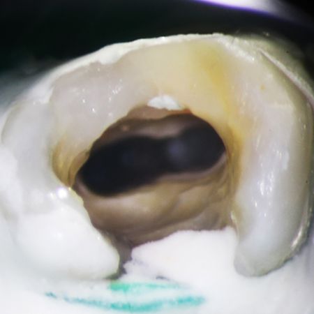 Retreatment efficacy of gutta-percha removal using an operating microscope and ultrasound