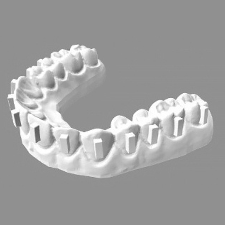 The effect of using dental loupes on the accuracy of aligner attachments and flash adhesive area after bonding
