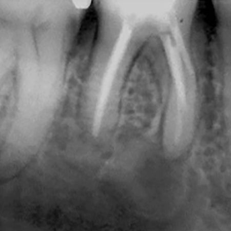 Canal médio-mesial tipo confluente em molar inferior, e sua importância no tratamento endodôntico: caso clínico