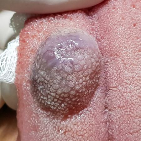 The use of sclerosing substance in the treatment of hemangioma on the dorsum of the tongue and its relation to pregnancy and lactation: a case report