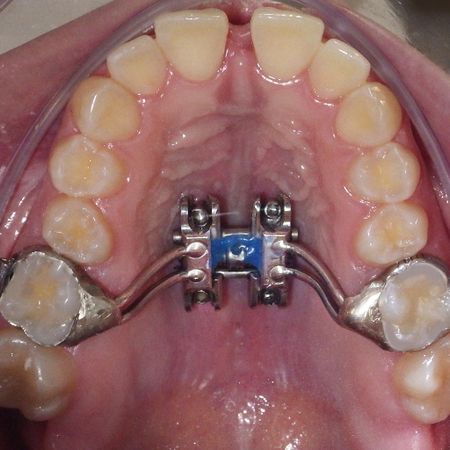 MARPE como coadjuvante do tratamento ortodôntico