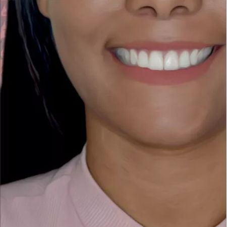 Managing Excessive Gingival Display with Maxillary Anterior Dentoalveolar Retraction, Intrusion, Miniscrews, Periodontal Surgery and Resin Veneers: Part 2