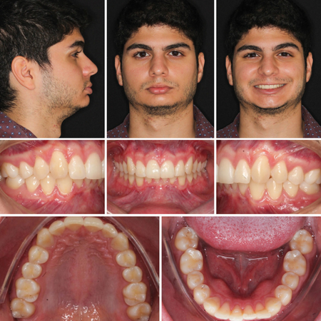 Orthodontic-surgical treatment of skeletal Class II malocclusion using aligners