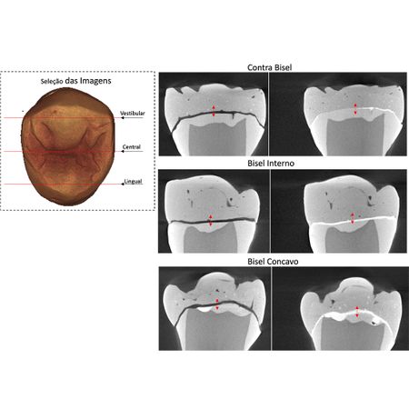 Different designs of finishing line for partial indirect restorations: mechanical behavior and adaptation in vitro