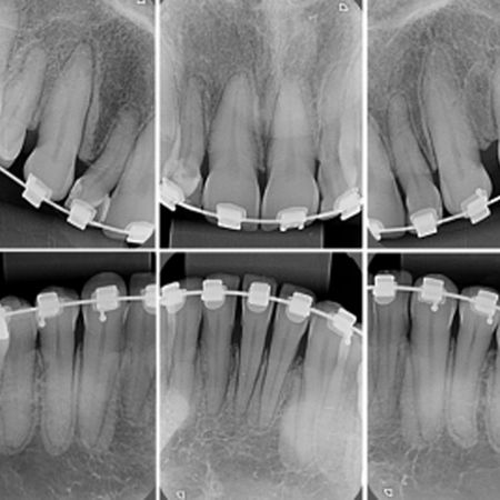 Influência do risedronato na movimentação dentária ortodôntica em roedores: revisão sistemática e um relato de caso